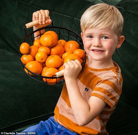 Six Year Old Boys Skin Turns Yellow Because He Eats So Many Oranges