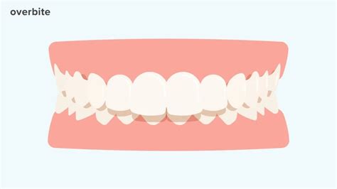 Buck Teeth Causes Symptoms And Treatments For An Overbite