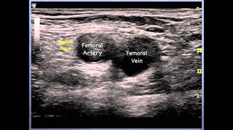 Femoral Nerve Sonoanatomy Qmh Aed Ultrasound Casebook 2013 Video