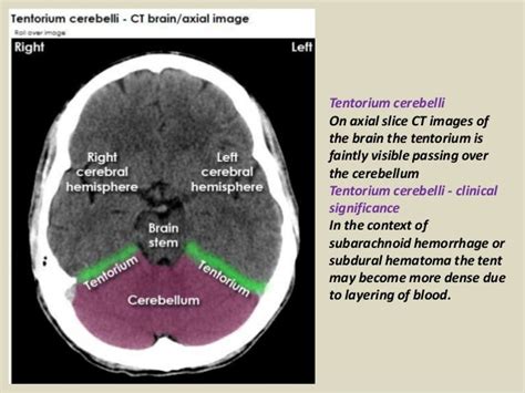 Presentation1pptx Radiological Anatomy Of The Brain