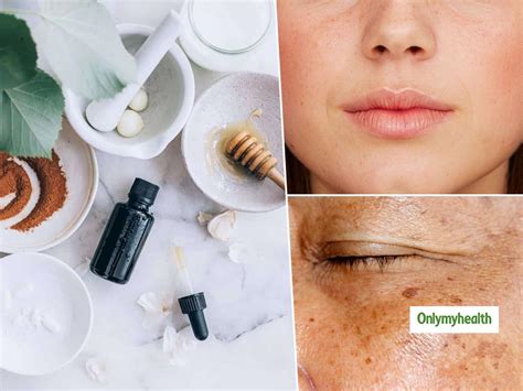 Hyperpigmentation Skin Treatment How To Get Crystal Clear Skin