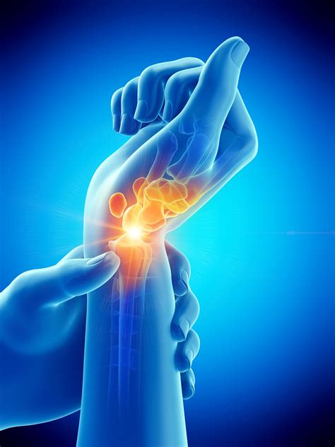 Medically reviewed by william morrison, m.d. Carpal Tunnel Syndrome Bitesized CPD - Reinge Education