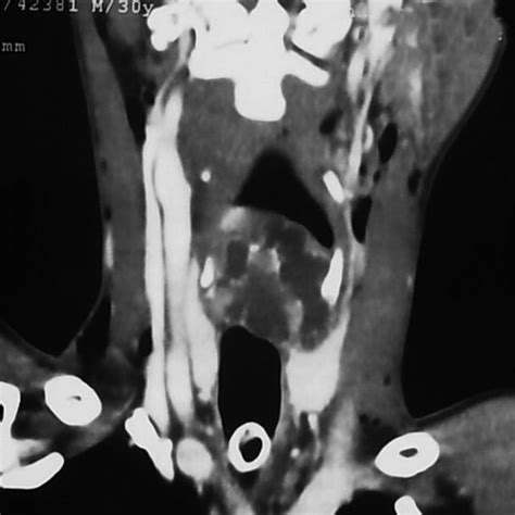 Cect Neck Coronal Showing Soft Tissue Lesion In The Region Of The