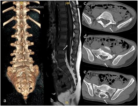 Spina Bifida Mri