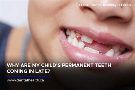 Why Are My Childs Permanent Teeth Coming In Late Kingsway Dental Health