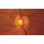Normal Optic Disc  American Academy Of Ophthalmology