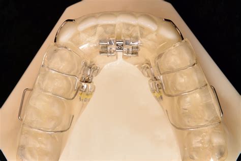 Removable Palate Expanders Parklund Orthodontic Lab