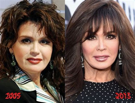 Marie Osmond Plastic Surgery Is It Really Just Botox