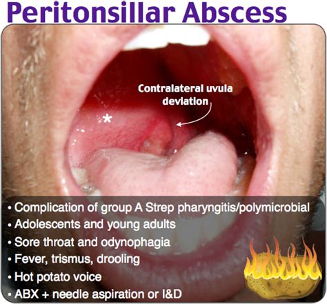 Peritonsillar Abscess Rosh Review Throat Medicine Emergency Medicine