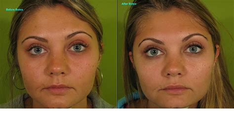 Eyebrow Lift Botox Before And After