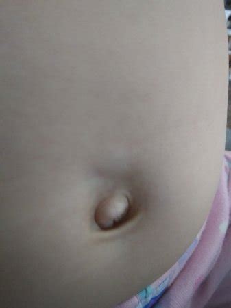 Stomach Lump Above Belly Button