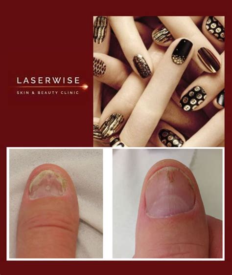 Nail Fungal Treatment Laserwise Skin Clinic