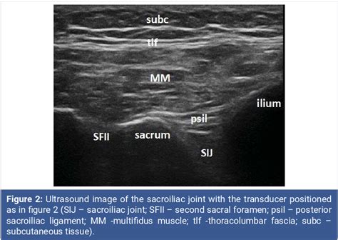 Ultrasound Guided Bilateral Si Joint Injection Sacroilliac Joint My