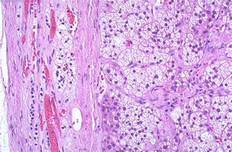 Pathology Outlines Adrenocortical Adenoma General