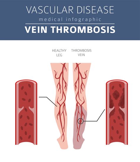 Deep Vein Thrombosis Dvt Symptoms Causes And Treatment