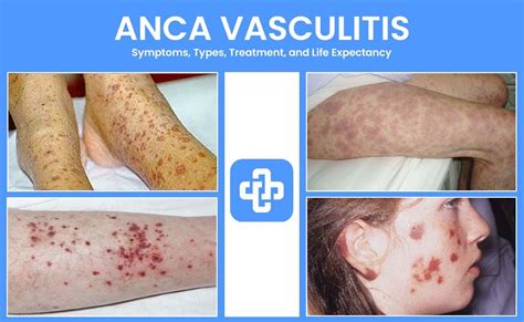 Anca Vasculitis Symptoms Types Treatment And Life Expectancy