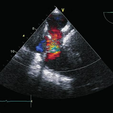 Mid Esophageal Dimensional Echocardiography Right Ventricular