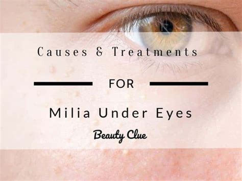 Milia Under Eyes White Bumps Causes Pictures Treatment Beautyclue