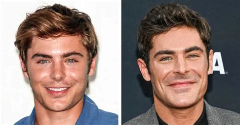 zac efron face accident the untold story behind his broken jaw