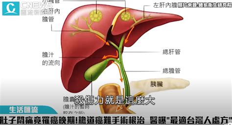 肚子悶痛竟罹癌晚期！膽道癌難拚手術根治 醫曝「最適台灣人處方」 中山醫達文西微創手術中心