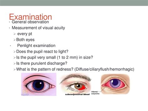Ppt Red Eye Powerpoint Presentation Free Download Id5338579
