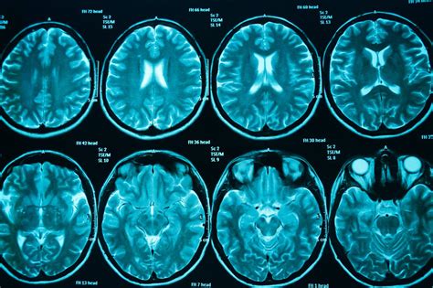 Stage Brain Cancer Prognosis Adults Cancerwalls
