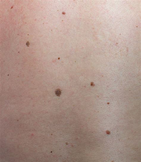 Close Up The Melanoma Black Spot On Human Skin Stock Image Image Of