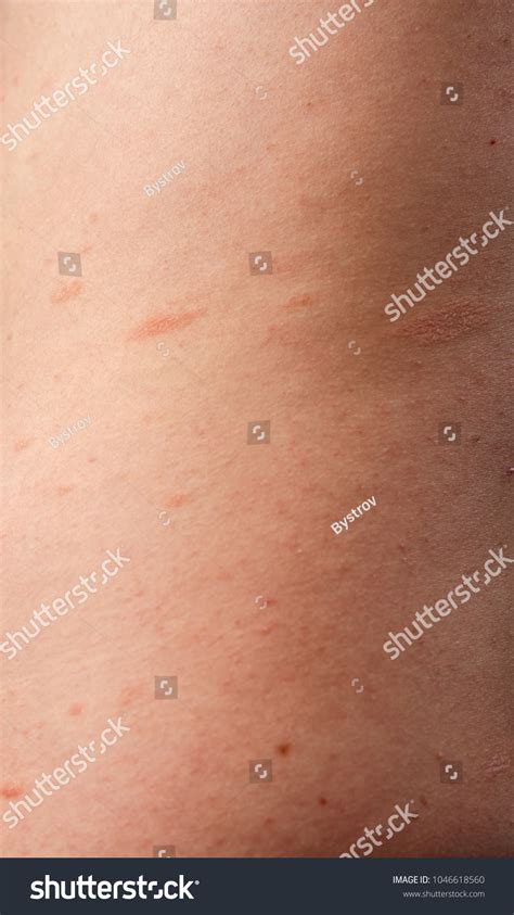 Pityriasis Rosea Herpes Red Spots On Stock Fotografie 1046618560