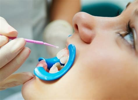 Fluoride Treatments Houston Tx Oral Health Sunrise Dental Center