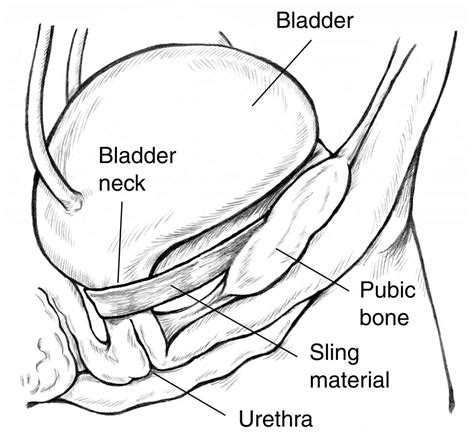 Sling Procedure For Urinary Incontinence