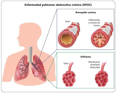 Bronquitis Cr Nica Vs Enfisema Pulmonar
