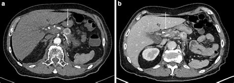 Computed Tomography Scans Of The Pancreas A Hypervascular Lesion In