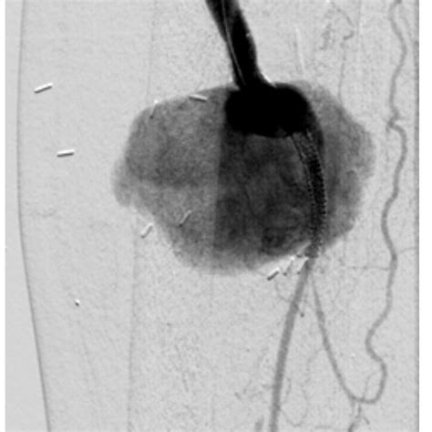 Peripheral Angiogram Of The Left Lower Extremity In Our Patient Reveals