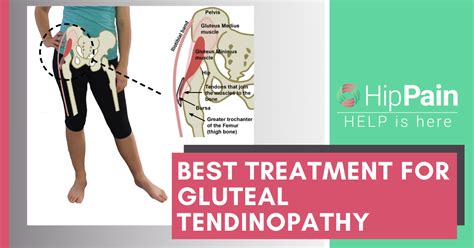 Best Treatment For Gluteal Tendinopathy And Trochanteric Bursitis