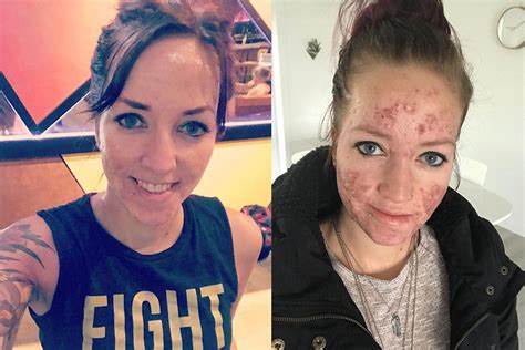 Woman With Severe Acne Reveals How The Agonizing Condition Left Her Too
