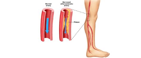 Peripheral Arterial Disease Vs Critical Limb Ischemia