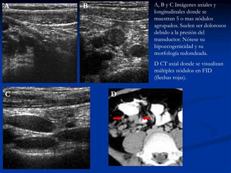 PPT HALLAZGOS ECOGRÁFICOS DE LA APENDICITIS AGUDA Y SUS PRINCIPALES