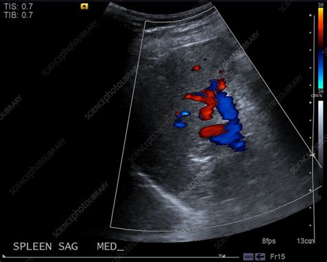 Normal Spleen Ultrasound Stock Image C0393203 Science Photo Library