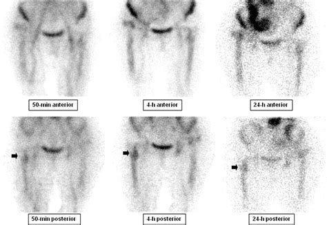 99mtc Hmpao Leukocyte Scintigraphy In Patients With Symptomatic Total