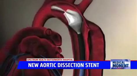 Medical Moment New Aortic Dissection Procedure At Spectrum Health
