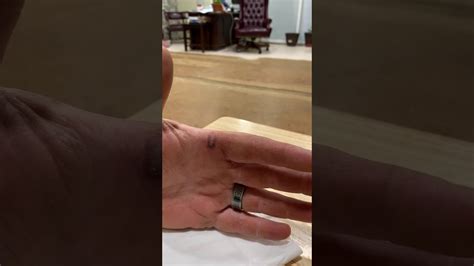 Popping A Blood Blister Youtube