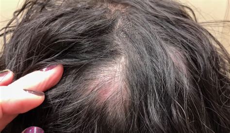 Pimple Popping Video This Woman Had Her Scalp Cyst Removed Hellogiggles