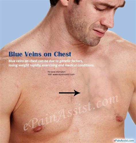 Blue Veins On Chest And Breasts Veins Vascular Disease Chest