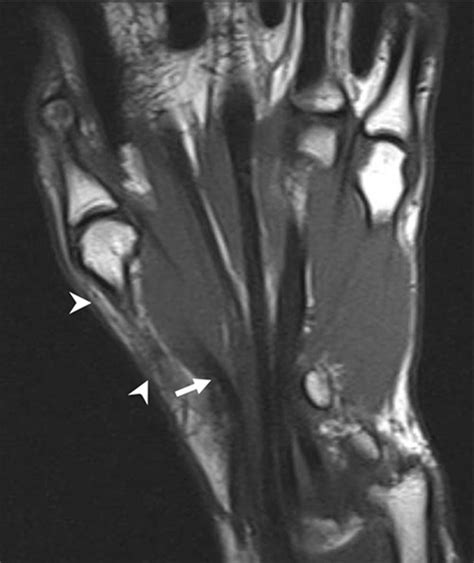 The csp was measured from the abductor pollicis brevis muscle. MrI coronal image shows abductor pollicis brevis muscle ...