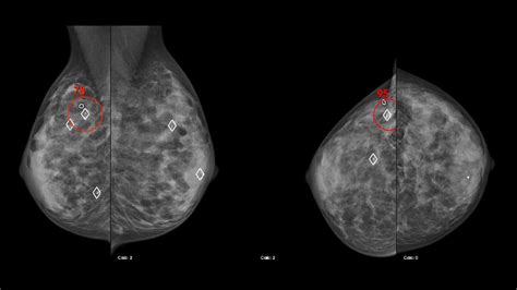 How Cad Can Help Save Time In Mammography Reading Siemens