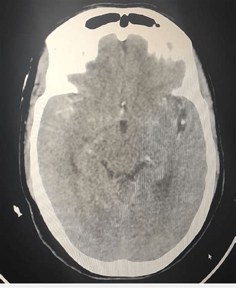 Plain Ct Scan Of The Brain Showing A Subarachnoid Hemorrhage Ct