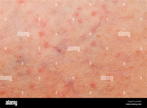 Close Up Picture Of Folliculitis Problem On Female Skin Stock Photo Alamy
