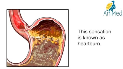 How Heartburn Works Animation Acid Reflux Disease Symptoms Causes And Treatments Video Gerd
