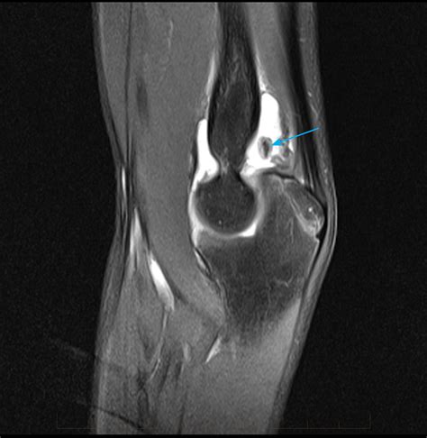 Elbow Mri Paediatic Mri Series Gp Referred