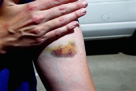 How To Make A Bruise Look Worse Without Makeup